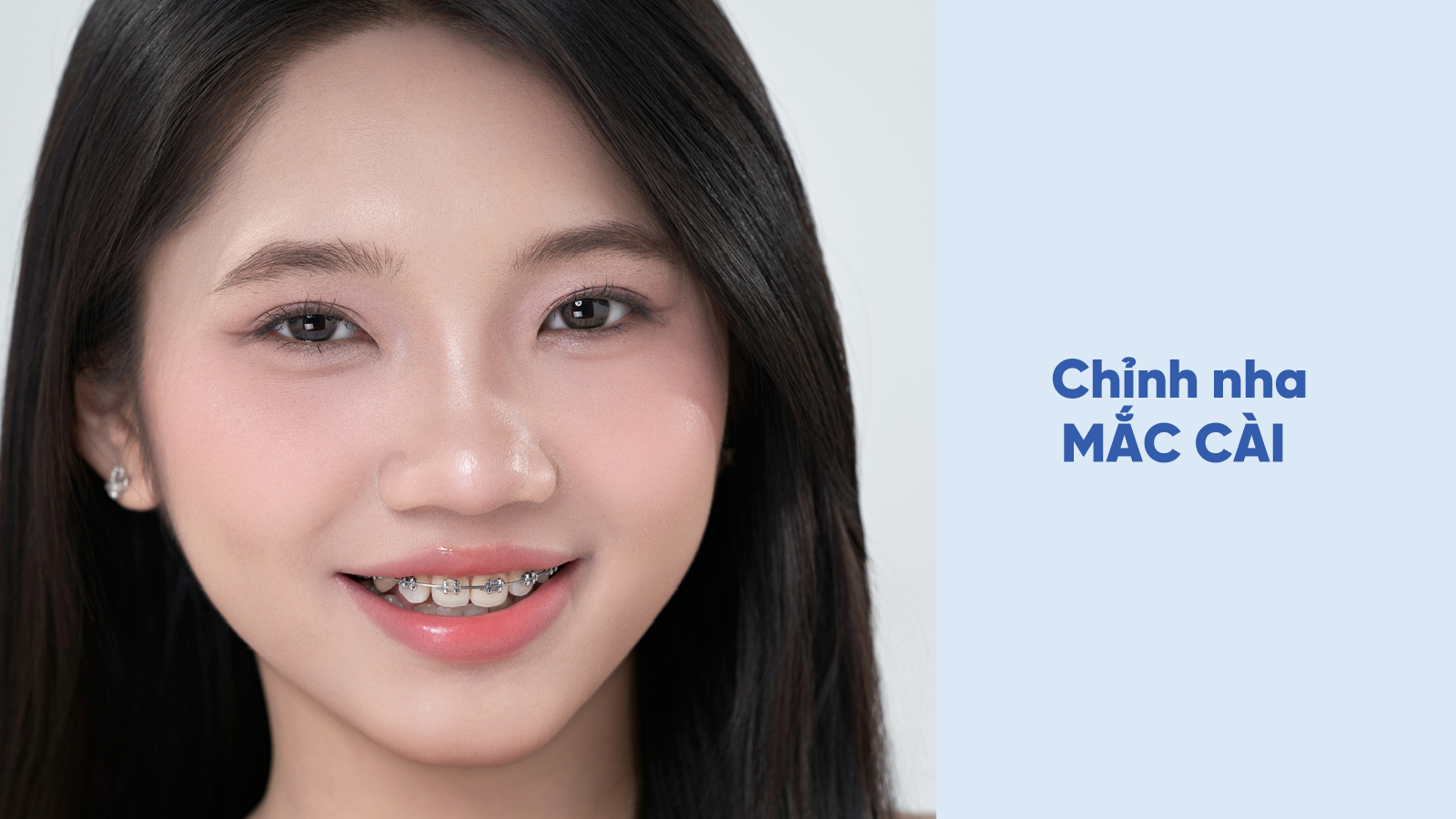 Chỉnh nha bác sĩ miên, chỉnh nha đắk lắk, niềng răng bác sĩ miên, nha khoa bác sĩ miên, niềng răng đắk lắk