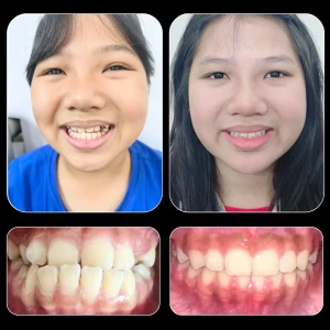 11. Chỉnh Móm hạng III (Nguyễn Phương Anh)