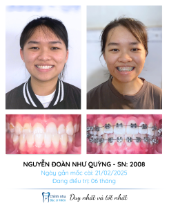 22. Chỉnh Móm (Nguyễn Đoàn Như Quỳnh)