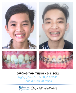 25. Chỉnh nha tăng trưởng (Dương Tấn Thịnh)